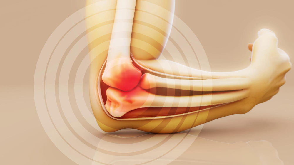 Tendonitis: Causes, Symptoms, Diagnosis, Treatment, and Prevention